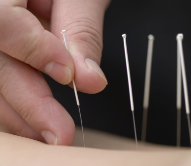 Agopuntura mal di testa, cervicale, sciatica